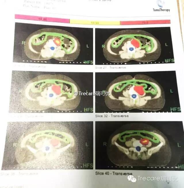 肩负生命的嘱托，瑞可优助力输尿管癌患者寻获生的希望